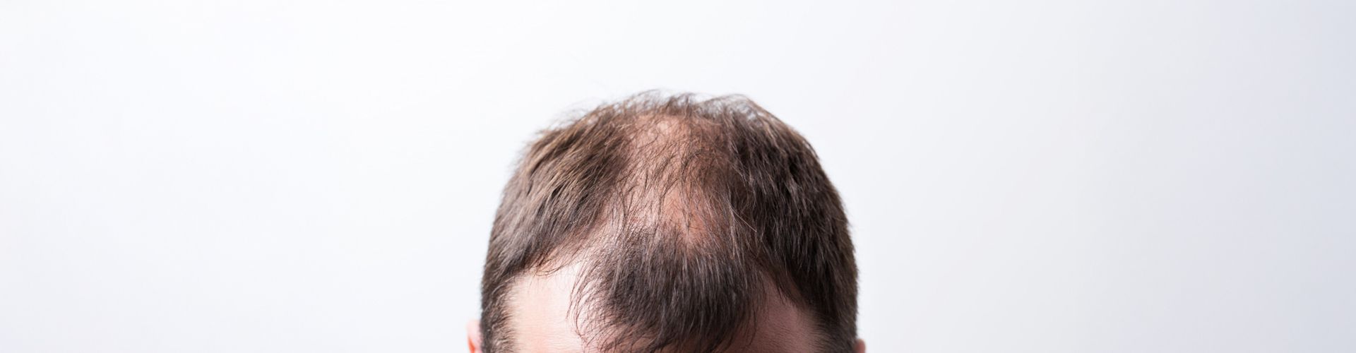 Soluciones avanzadas para la caída del cabello