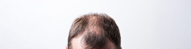 Soluciones avanzadas para la caída del cabello