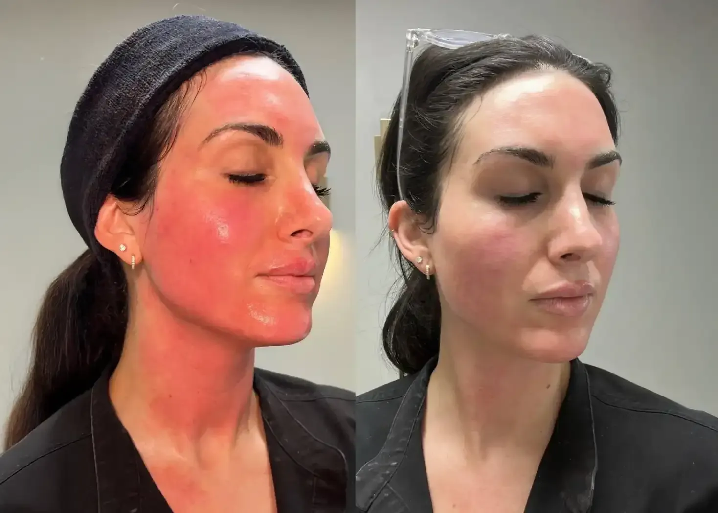 Dos fotografías comparativas de rostro femenino antes y después del tratamiento facial