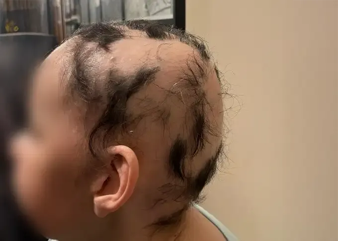 Inicio del tratamiento capilar