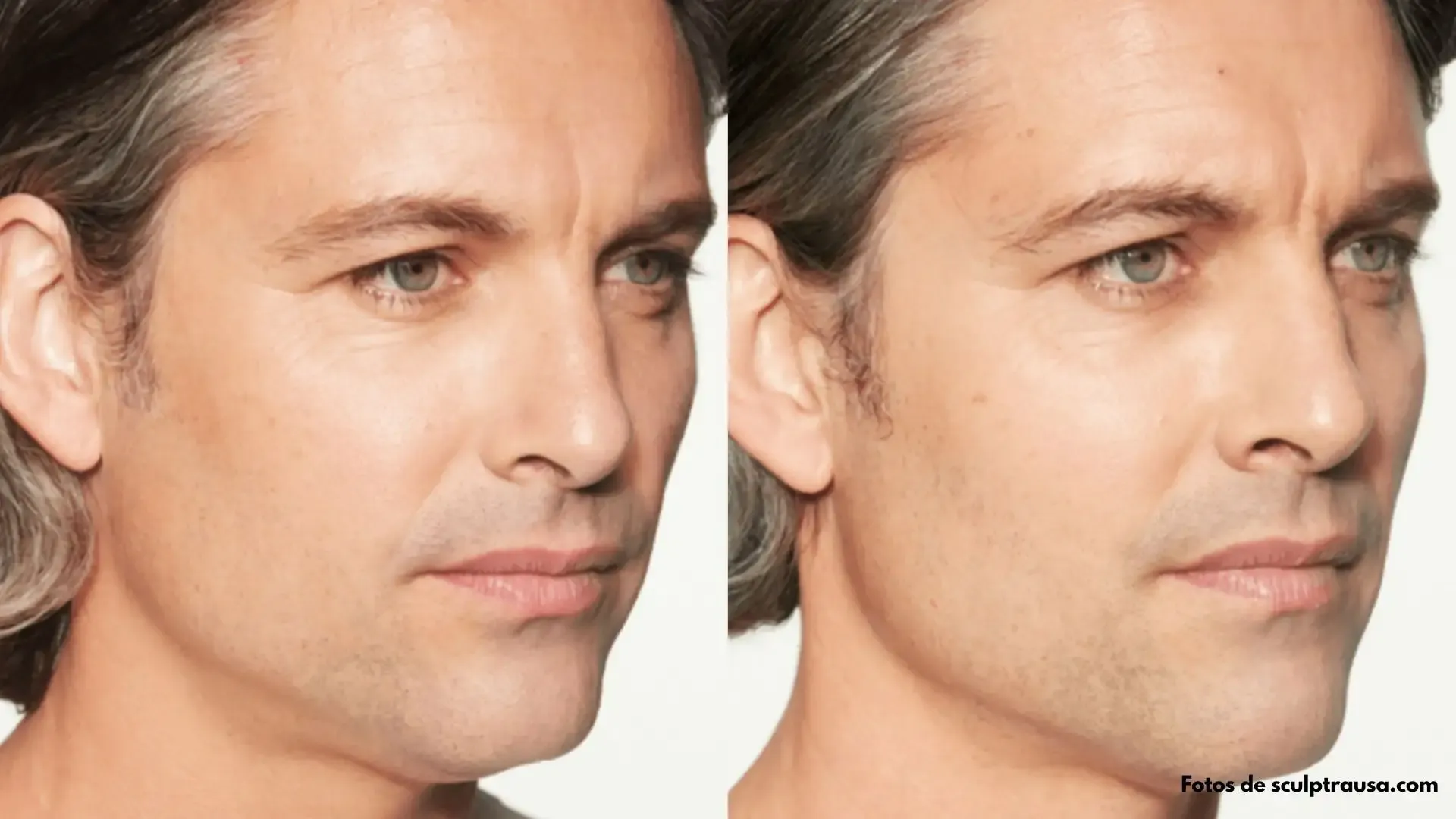 Sculptra - Resultados del tratamiento 2