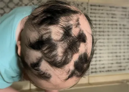 Durante el tratamiento capilar