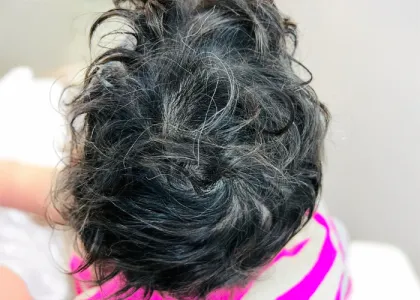 Seis meses después del tratamiento capilar