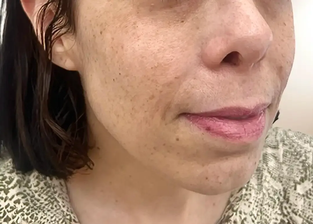 Antes de la corrección de tercio inferior y proyección de mentón