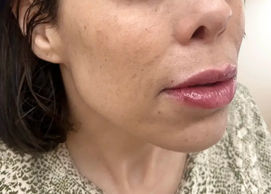 Después de la corrección de tercio inferior y proyección de mentón