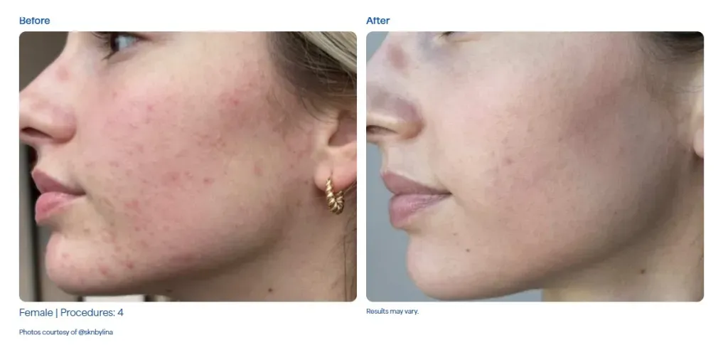 SkinPen - Resultados del tratamiento 2