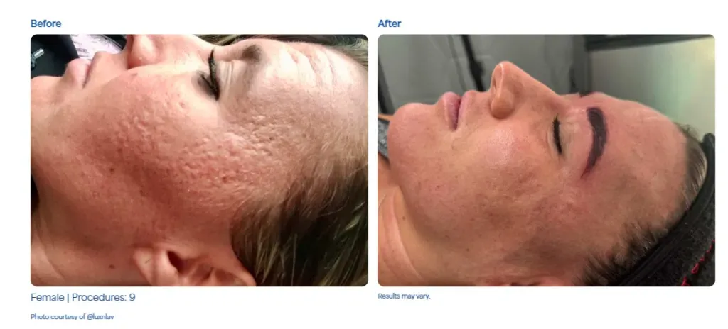 SkinPen - Resultados del tratamiento 1