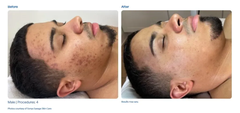 SkinPen - Resultados del tratamiento 3