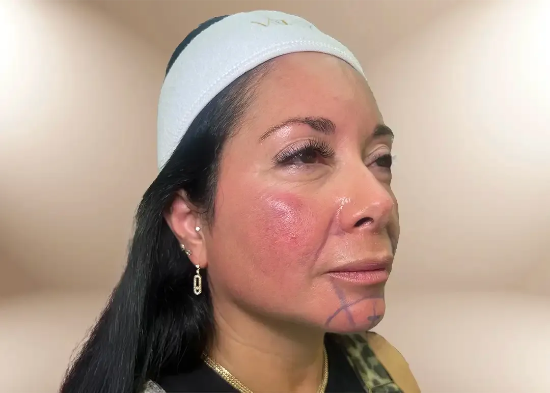 Antes de la corrección del tercio inferior