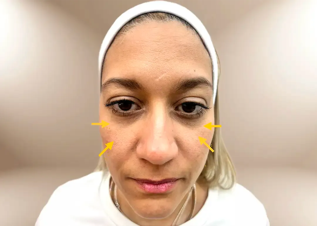 Antes de la reposición del tercio medio por pérdida de peso