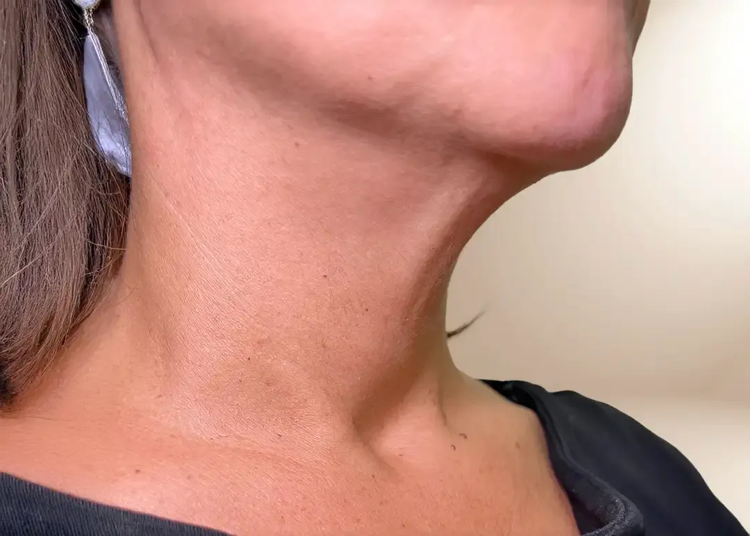 Antes de la bioestimulación de cuello con Radiesse