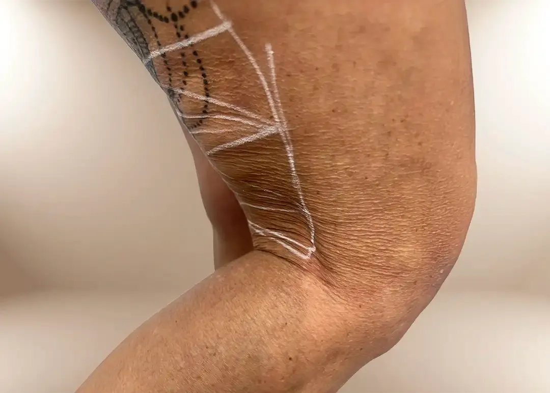 Antes de la bioestimulación de colágeno en piernas