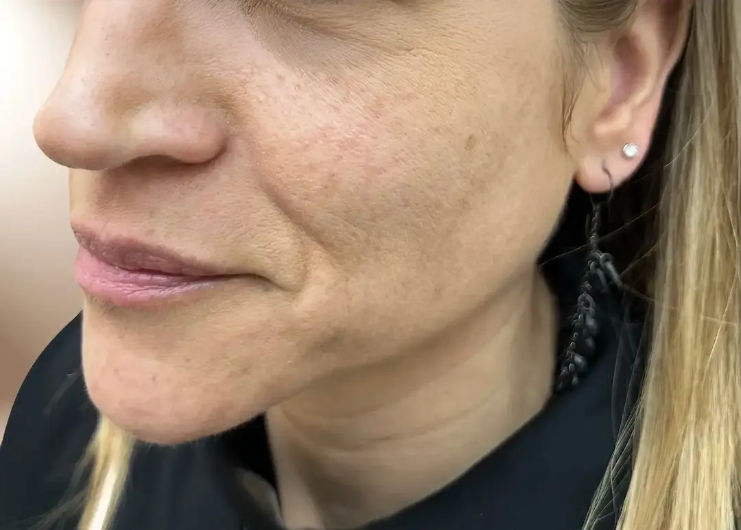 Antes del Aesthetic Facial Balancing para contornos faciales