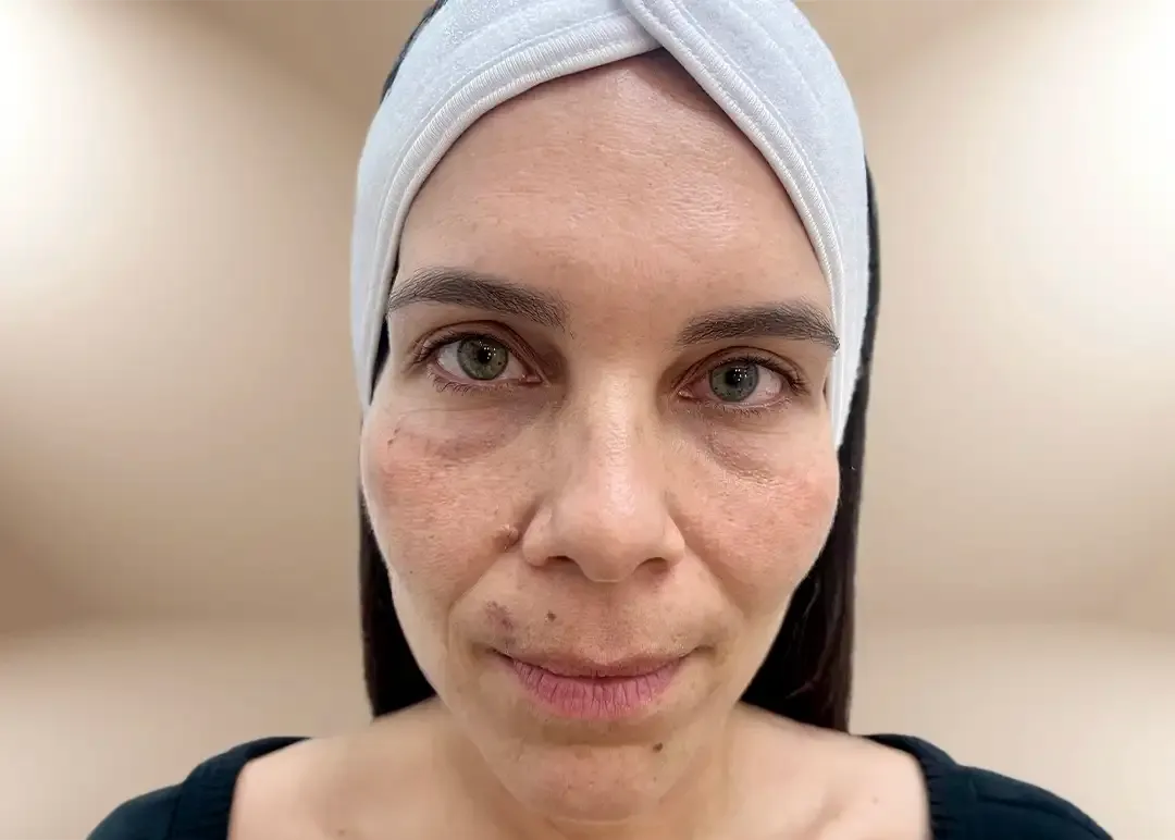 Antes del tratamiento de contorno de ojeras