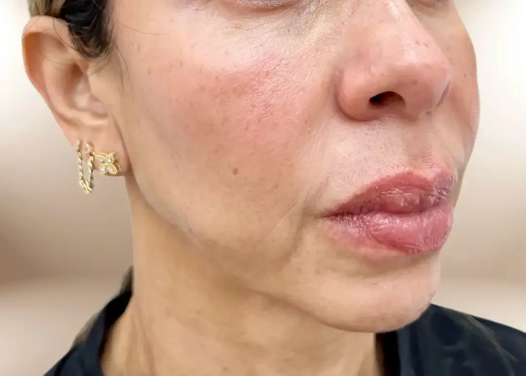 Antes de la corrección del tercio inferior por pérdida de peso