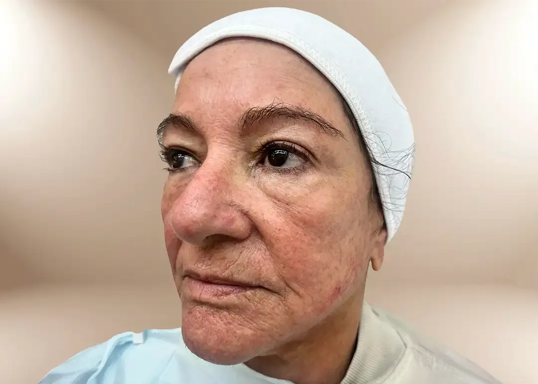 Antes del tratamiento Aesthetic Facial Balancing en paciente con GLP-1