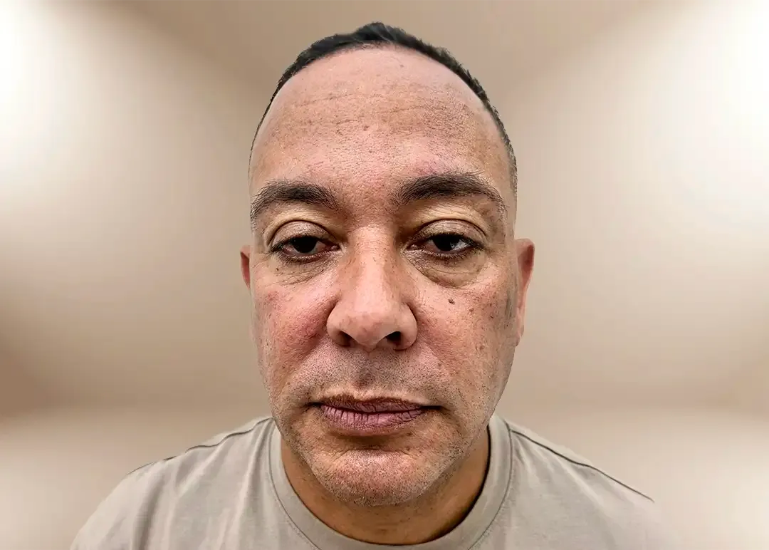 Antes del contorno de la región malar por pérdida de peso