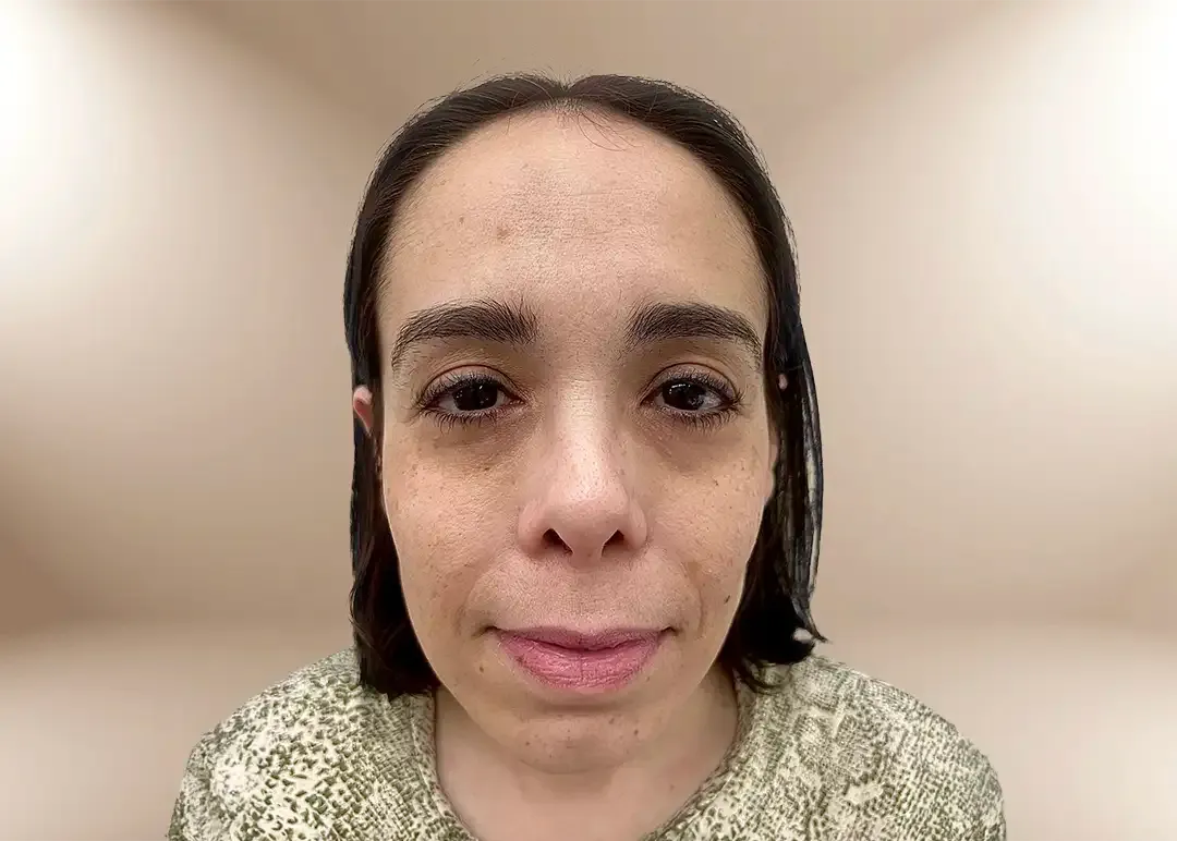 Antes de la corrección de tercio inferior y proyección de mentón