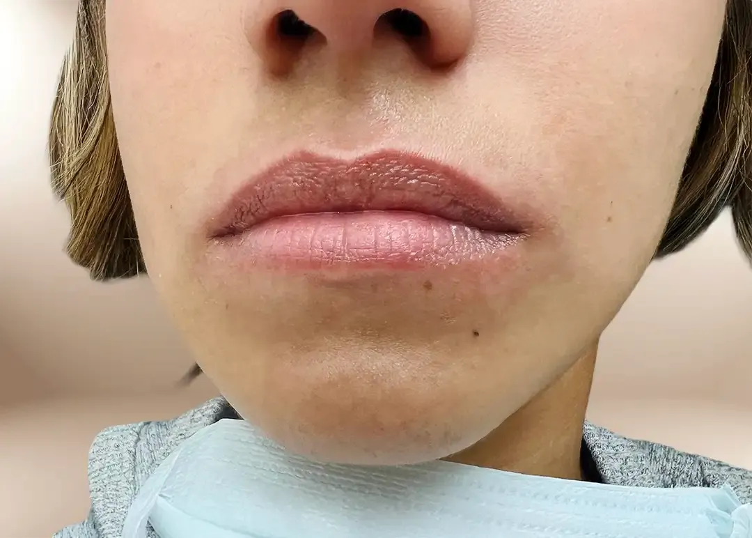 Antes de la proyección de labio con Lip Filler