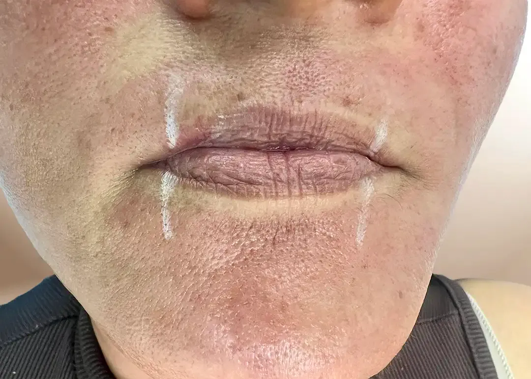 Antes de la restauración de labio invertido con Lip Filler