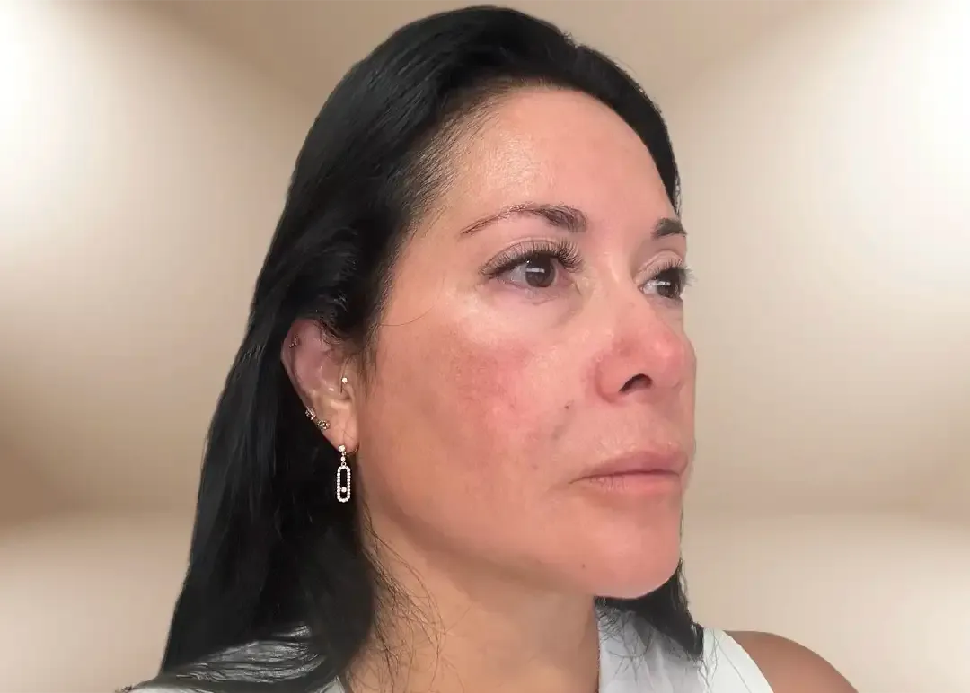 Después de la corrección del tercio inferior