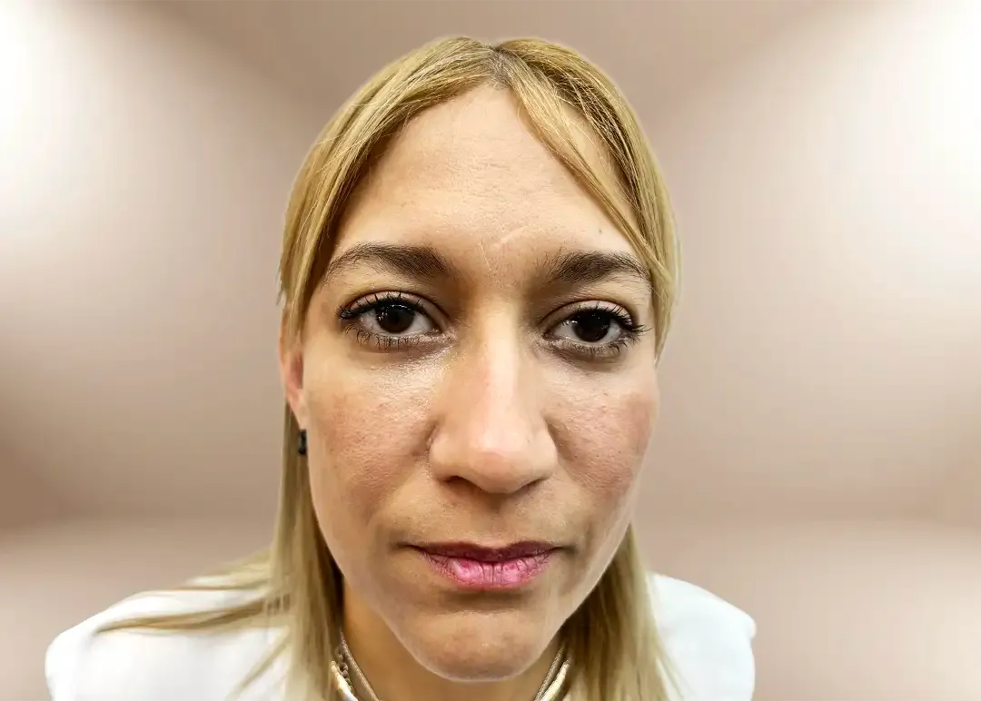 Después de la reposición del tercio medio por pérdida de peso