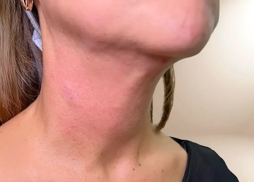 Después de la bioestimulación de cuello con Radiesse