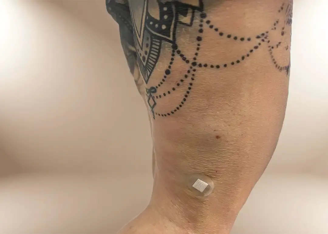 Después de la bioestimulación de colágeno en piernas