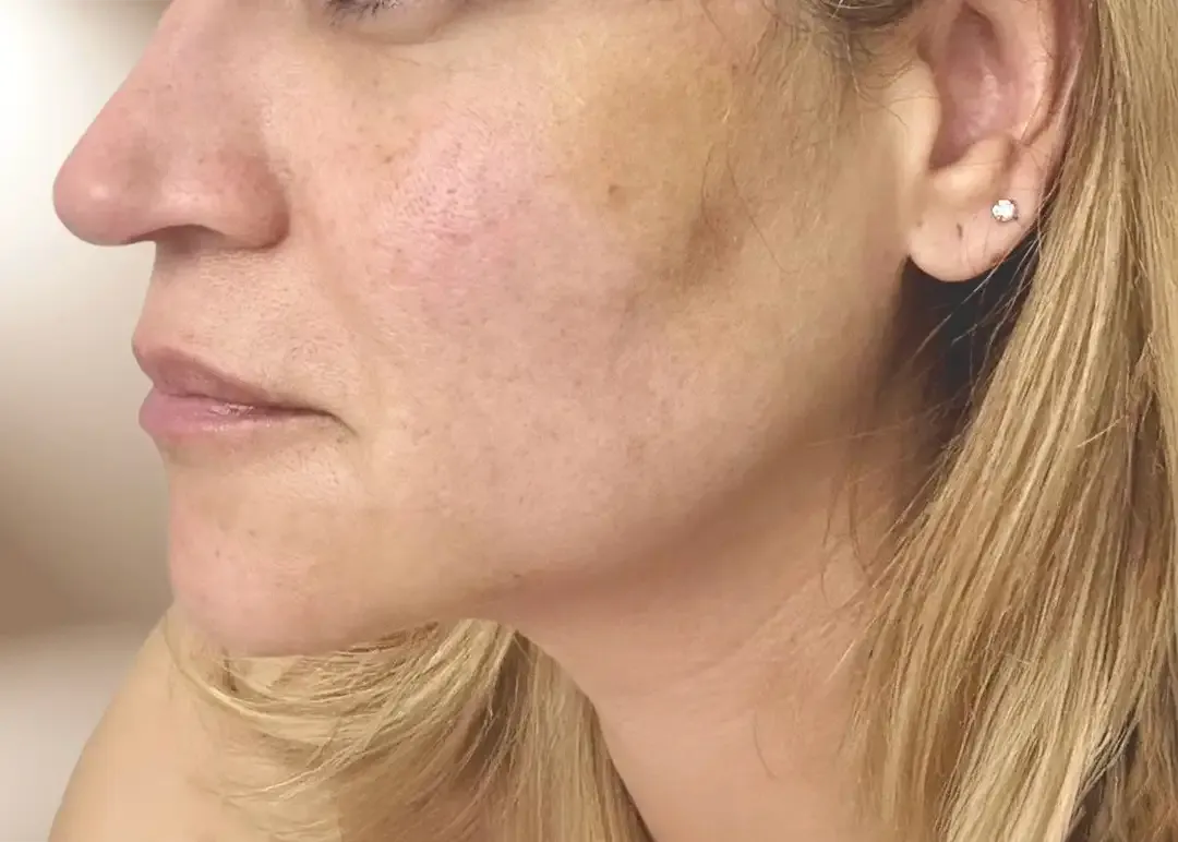 Después del Aesthetic Facial Balancing para contornos faciales
