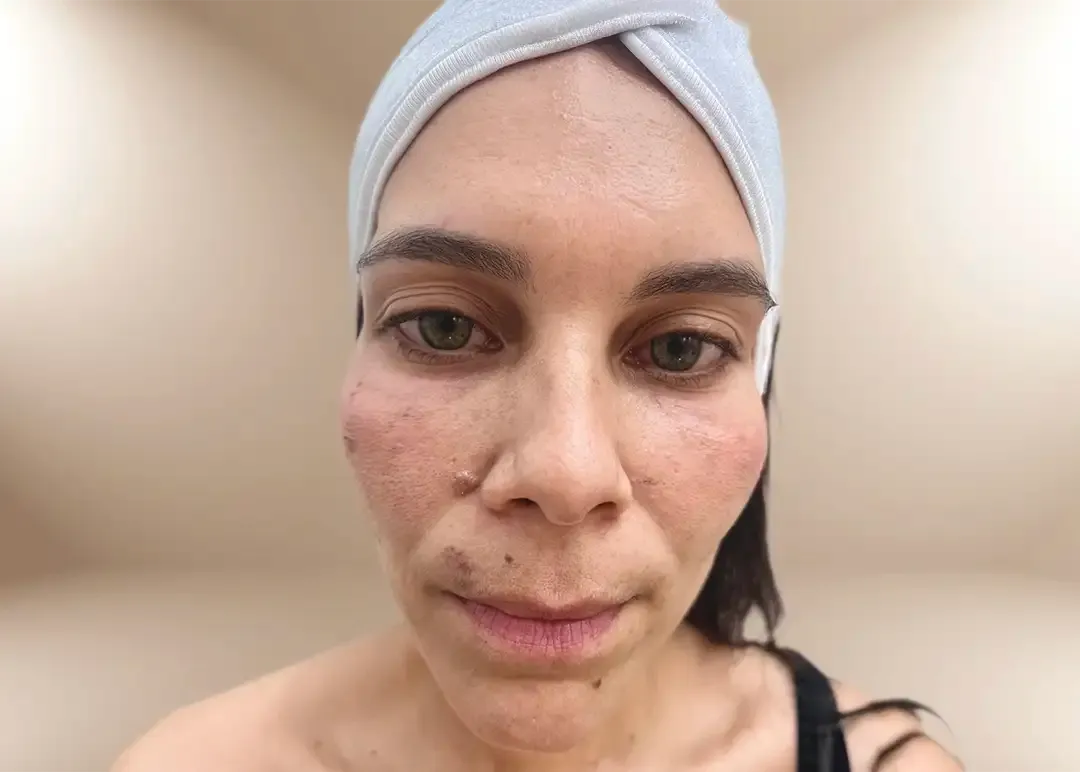 Después del tratamiento de contorno de ojeras