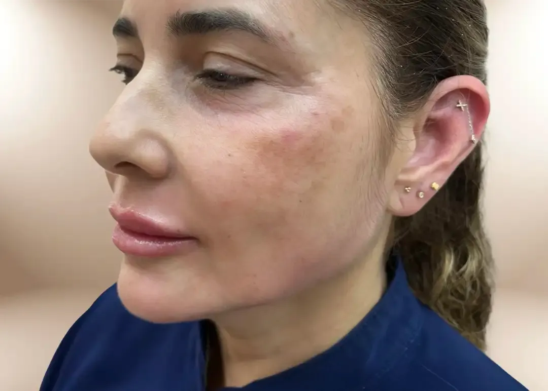 Después del tratamiento Aesthetic Facial Balancing (resultado a 1 año)