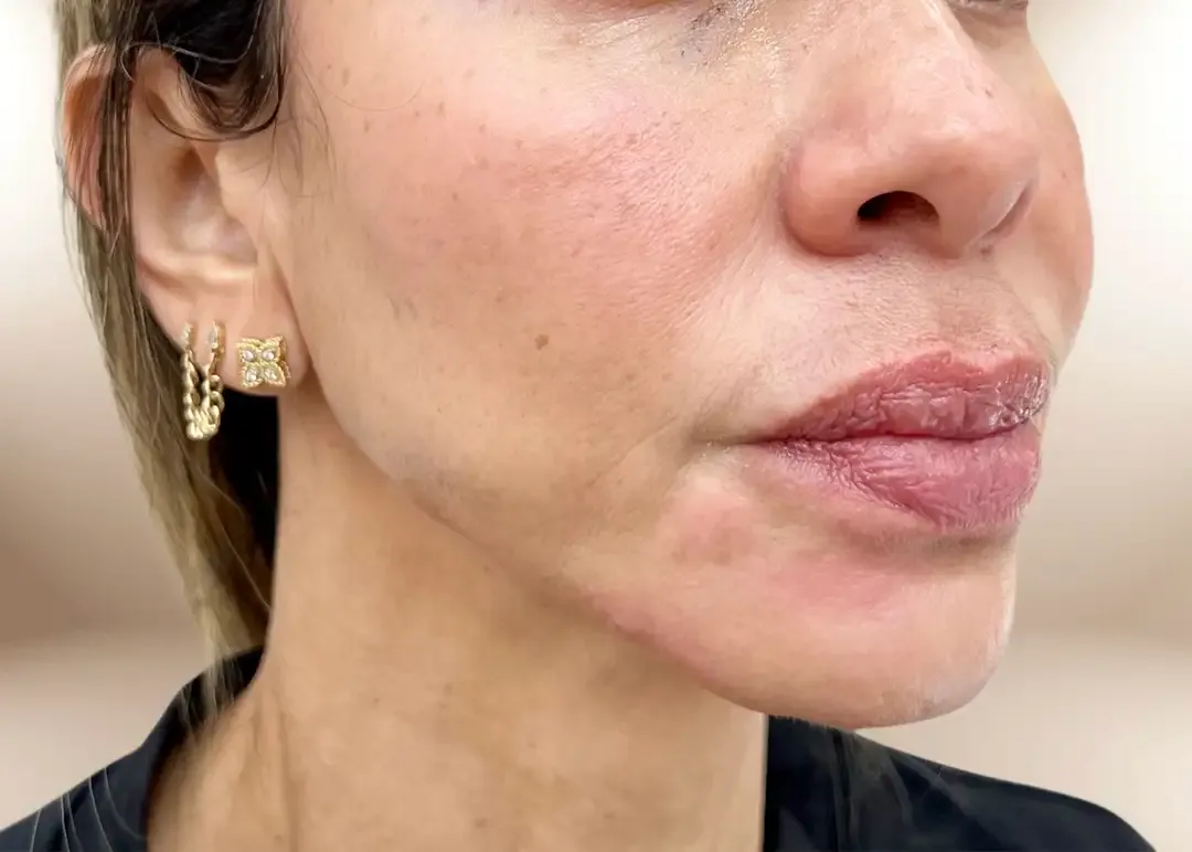 Después de la corrección del tercio inferior por pérdida de peso