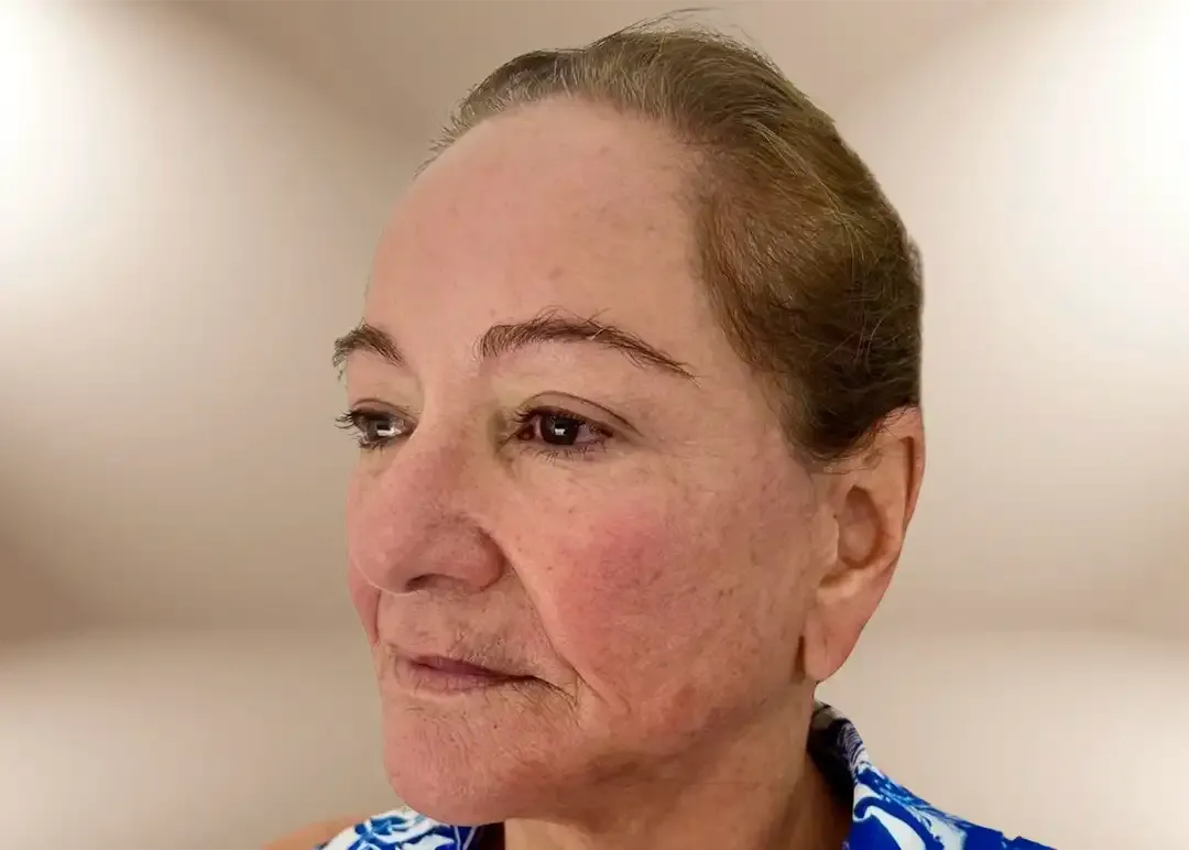 Después del tratamiento Aesthetic Facial Balancing en paciente con GLP-1