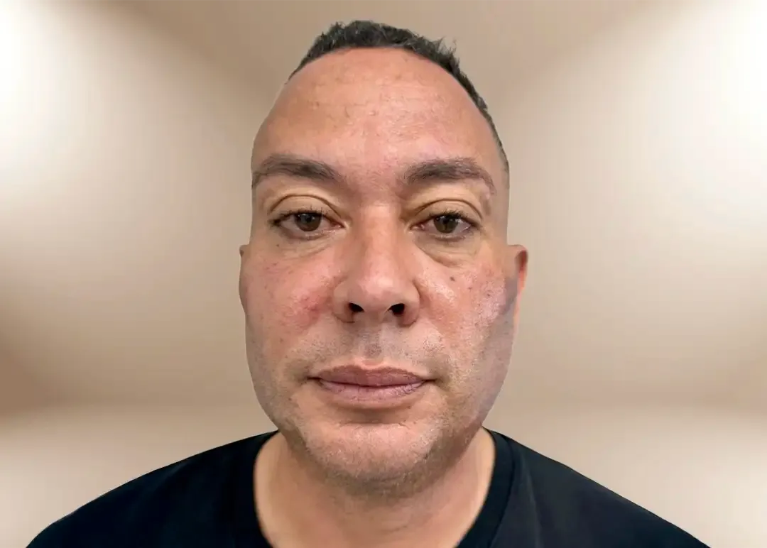 Después del contorno de la región malar por pérdida de peso