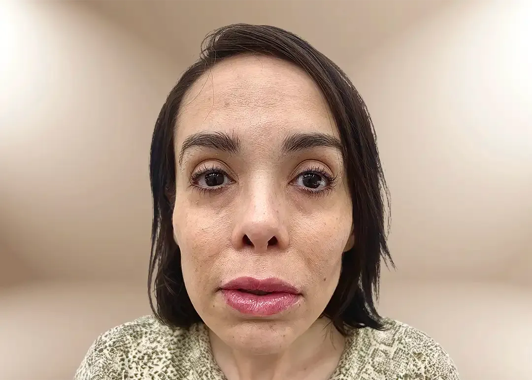 Después de la corrección de tercio inferior y proyección de mentón