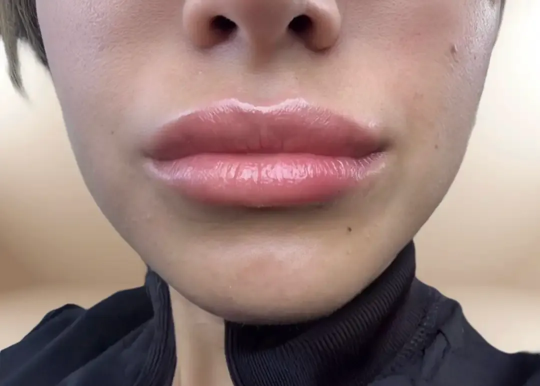 Después de la proyección de labio con Lip Filler