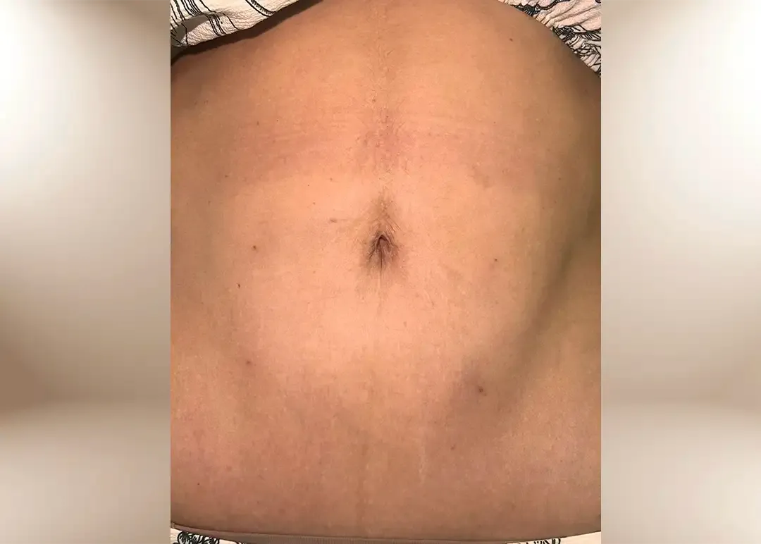 Después del tratamiento de tensado abdominal post-parto