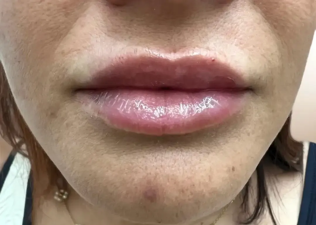 Después de la restauración de labio invertido con Lip Filler