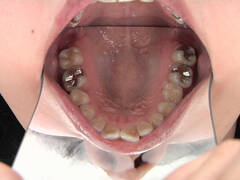 銀歯インレーフェチ 咲希の口内には銀歯がいっぱい!