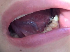 本物歯科治療映像 左下6,7番銀歯治療 星野桃子