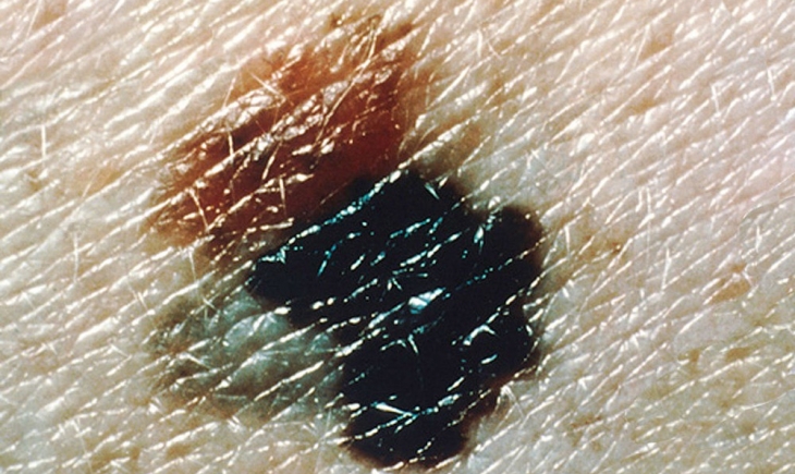 Taxa de mortalidade por melanoma aumentou em homens, diz estudo