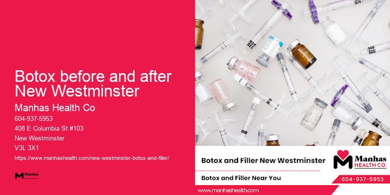 Botox for crow's feet and lines Botox before and after New Westminster