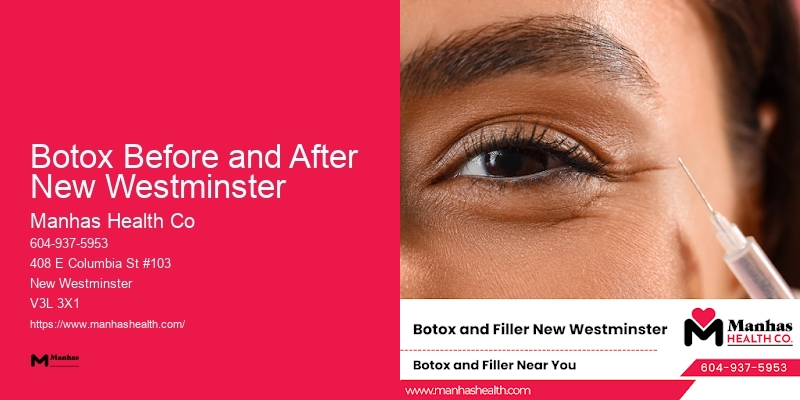 Advanced Botox Cosmetic Procedures Botox Before and After New Westminster