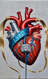 LVAD heart